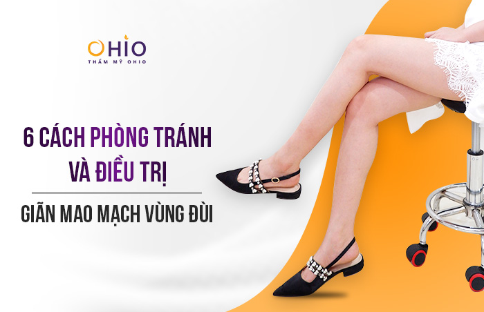 Trị giãn mao mạch vùng đùi hiệu quả