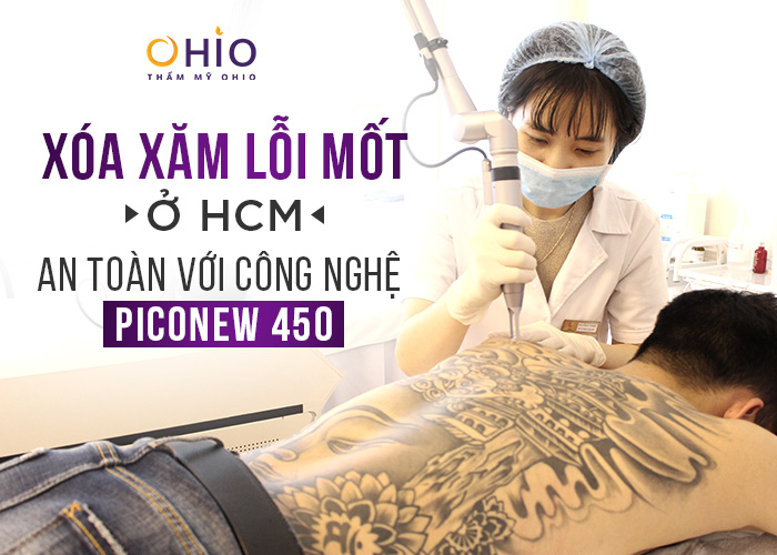 Xóa xăm lỗi mốt hcm