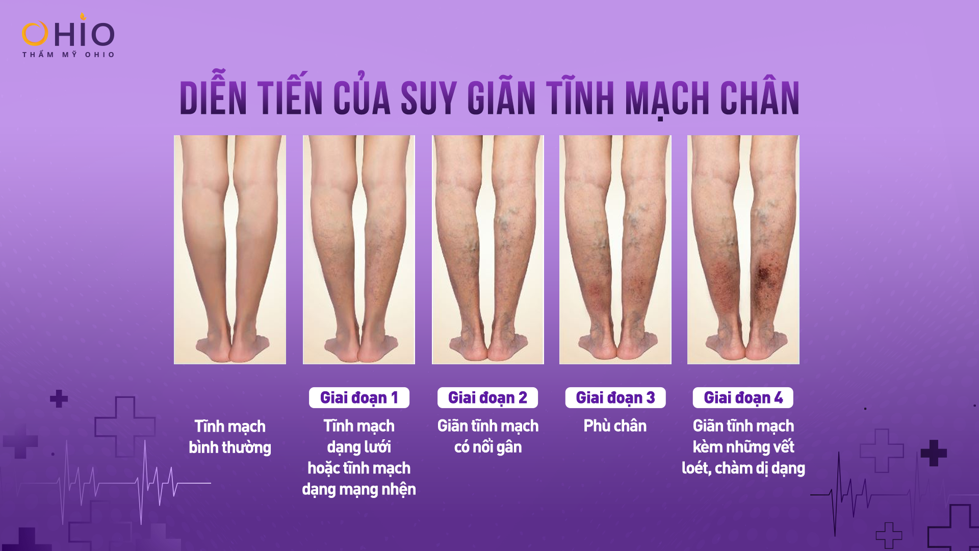 trị suy giãn tĩnh mạch ở nhà